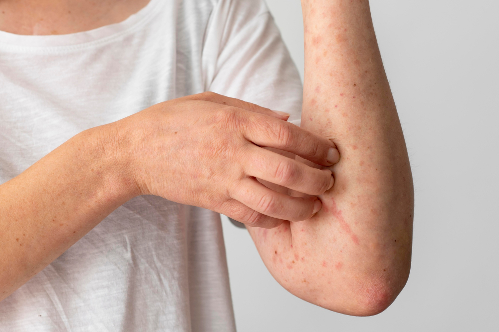 Reakcja alergiczna skóry na chemię zawartą w konwencjonalnych środkach czystości.